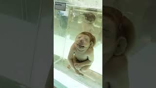 Different types of Congenital Anomalies in the premature infants. #Birthdefects