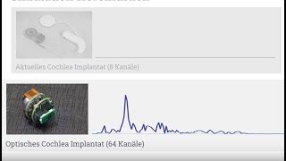 Wie hört man mit einem Cochlea-Implantat?