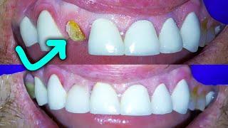 Broken Front Tooth Repair By A Dentist! How to Fix a Crown Fractured at Gumline!