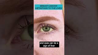 Identifying Symptoms of Breast Cancer Metastasis to the Liver ️#Cancer #Metastasis #LiverMetastasis