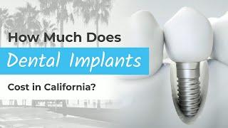 What's the Cost of Dental Implants in California?