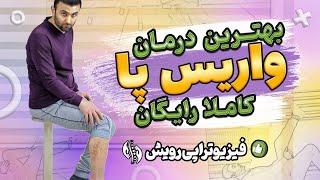 درمان واریس پا و درد پای آن با حرکات و ورزش های اختصاصی | Varicose veins treatment at home