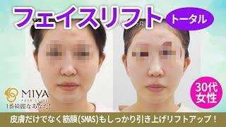 【顔のたるみ取り・切開リフト】フェイスリフト(トータル)の施術と症例 ／MIYAフェイスクリニック