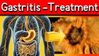 Top 5 Signs You Have Gastritis: Ultimate Guide to Gastritis: Symptoms, Causes, and Treatments