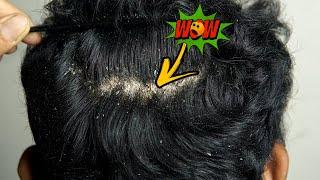 Huge Dandruff Scratching In Hire!! Dandruff Removal At Home