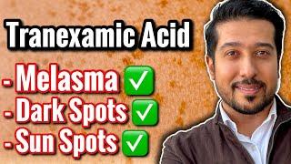 3 BEST Tranexamic Acids for Melasma and Discoloration (not sponsored)