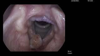 Vocal Cord Polyp Microlaryngeal Surgery