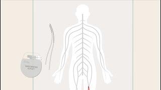 Boston Scientific - How SCS Works