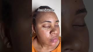 Acne Journey Credits : helloperfectskin clinic via IG #acnejourney #acnetreament