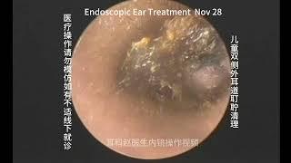 Cleaning of bilateral external auditory canal cerumen embolism in children 20241128