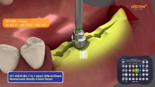 Esset kit OSSTEM, Kompodent