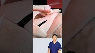 Trật khớp cùng đòn vai