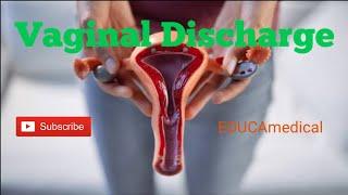Vaginal Discharge: Causes, Signs, and Treatment