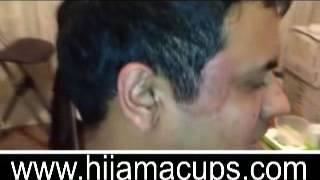 Hijama Lesson 6 الحجامه  Cupping The Side Of The Head Temple Area