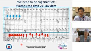 Cardiac EP in Everyday Practice Season 4: What not to miss in an ECG stress test?