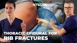 Thoracic Epidural Analgesia: Technique