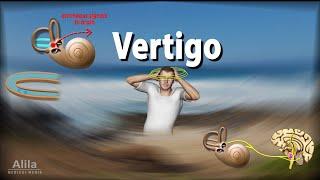 Vertigo: Causes, Pathophysiology and Treatments, Animation