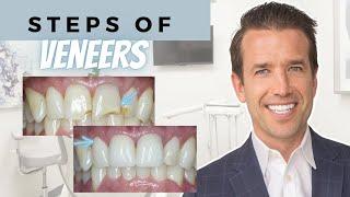 Are Veneers Worth It? You have options!