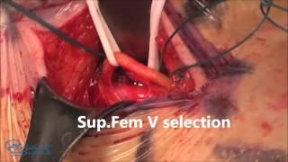 Deep Venous insufficiency  CHIVA diagnosis and treatment
