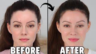 Rogaine Before & Afters: 5 Months, Hairline RESULTS!