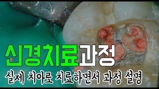 치아 신경치료 과정 [실제 치아로 치료하면서 과정 설명]