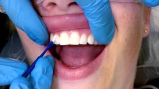 Tips For Applying Fluoride Varnish