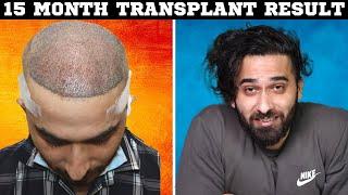 FUE Hair Transplant 15 MONTH RESULT I Before & After | Born Creator