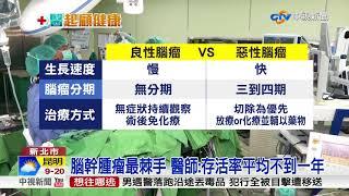 無聲殺手! 腦瘤症狀易混淆 患者"青壯年"占多數│中視新聞 20180318