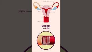 ️ Blocked Fallopian Tube ? Fallopian Tube Blockage Yoga | Exercise | #exercise #yoga #shorts