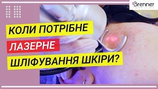 Лазерная шлифовка лица | Brenner Clinic | Клиника доктора Бреннера