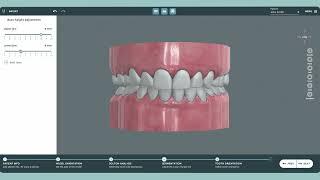 Measuring & Adjusting Gingival Height Base