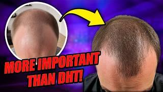 Is DHT The ONLY Cause of Male Hair Loss?