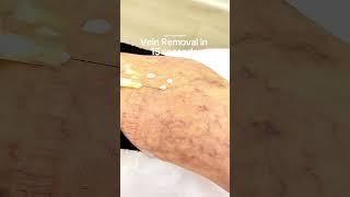 Non-Surgical Vein Removal