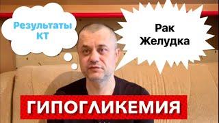 Рак Желудка - Результаты КТ. Галлюцинации и приступ гипогликемии. Было очень плохо и страшно.