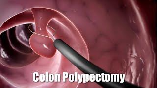 Removing a polyp from the colon (3D Animation)