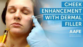 Cheek Enhancement with Dermal Filler | AAFE