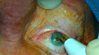 Conjunctival cautery for conjunctivochalasis