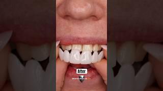 Snap On Veneers: Instant Smile Makeover