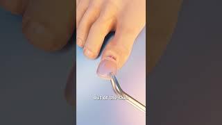 How Toenail Removal Works 