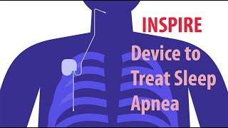 INSPIRE Upper Airway Stimulation zur Behandlung von Schlafapnoe