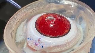 Dr. Sergio Canabrava´s Four- Flanged Scleral Fixation Technique - CODET Vision Institute