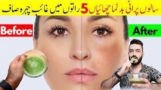 20 years old Pigmentation will completely disappeared in 5 nights | Get Rid of Pigmentation melasma