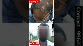 Best Hair Transplant Results in Tamilnadu | Before & After HT Results | Hair World Clinics