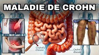 SYMPTÔMES les plus fréquents de la MALADIE DE CROHN