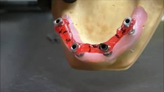 Mode Implant Quattrofix Prosthesis