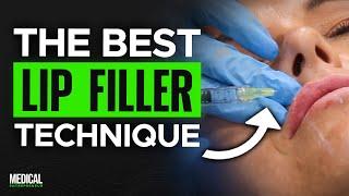 Lip Augmentation Technique for Perfect Lips | Full Procedure Demonstration