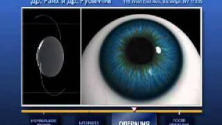 Dr. Rubinchik Cataract Commercial in Russian