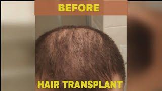 Hair Transplant Turkey 2019, FUE Method - Before Video