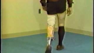 Gait deviations relating to a transtibial prosthesis.