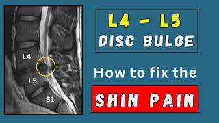 How to fix Shin pain due to lumbar L4 - L5 disc bulges